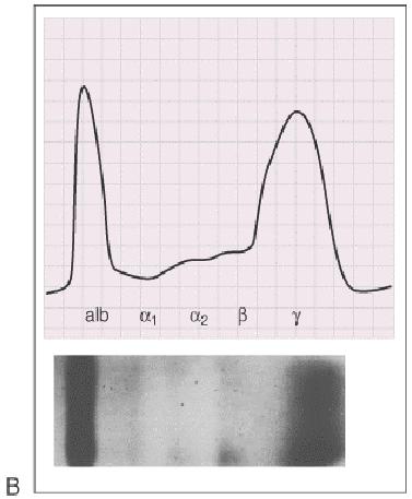 Plasma hücresi hastalıklarında Gamma bölgesinde sivri dar tabanlı bir pik (M proteini)