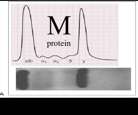 Myelomalarda M Proteini: % 75-80 intak (Ig