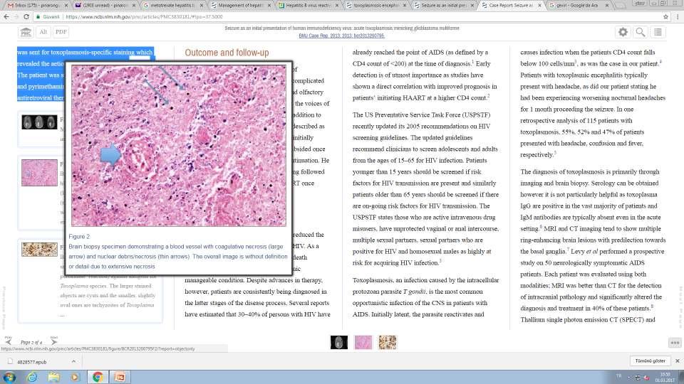 OLGU 1 Beyin biyopsisi: Şiddetli nekroz, glioblastom mul:forme ile uyumlu Malign hücre Ø Bu nedenle