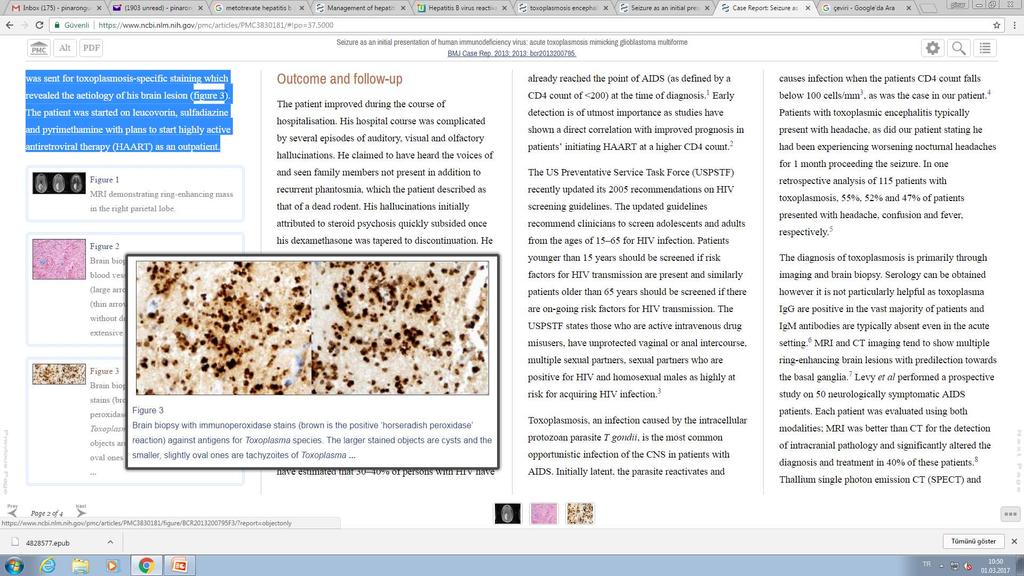 OLGU 1 HIV pozi0f doğrulama pozi0f CD4: 17 hücre/ µl Toksoplazma düşünülmüş: Serum toxoplasma IgG pozi:f (900 IU/ml) ( 12 IU/mL pozi0f) Lökoverin +