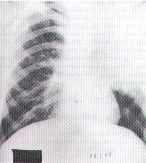 Legionella antijeni - - ± Torasentez - - Oksijen satürasyonu ölçümü ±