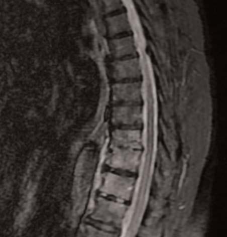 Ataman Hatipoğlu Ç, Arslan K, Bulut C, Koçak Tufan Z, Evaluation of Epidemiological, Clinical and Laboratory Characteristics of Patients with Spondylodiscitis nedeni kanser metastazı olan iki hasta