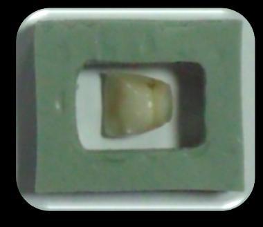 kullanıldı. Pürüzsüz, düzgün ve standart mine yüzeyi elde edildi. Resim 2.2. Dişlerin gömülü olduğu akril blokların elde edilmesi Açıkta kalan mine yüzeyinde 3 x 6mm lik bir dikdörtgen çizildi.