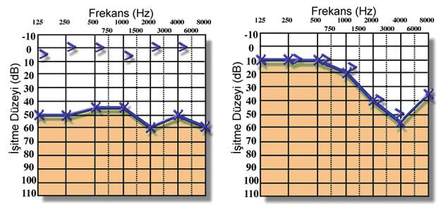 MOLEKÜLER BİYOFİZİĞE GİRİŞ 293 Odiyogram (audiogram) örnekleri: Solda, iletim tipi işitme kaybına ait odiyogram; ağ tarafta ise sinirsel tip işitme kaybına ait bir odiyogram görülmektedir. 11.2.5.