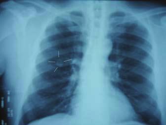 Orta derecede pulmoner semptomlar infeksiyoz hastalıklarda lezyona eşlik edebilir. Semptomlar SPN nin varlığı ile korele olabilir veya olmayabilir.