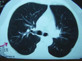 Resim 2. BT de sağ akciğer üst lob posterior segmentte görülen düzensiz kenarlı (ok) nodül, patoloji sonucu bronş karsinomu olarak geldi. Resim 3.