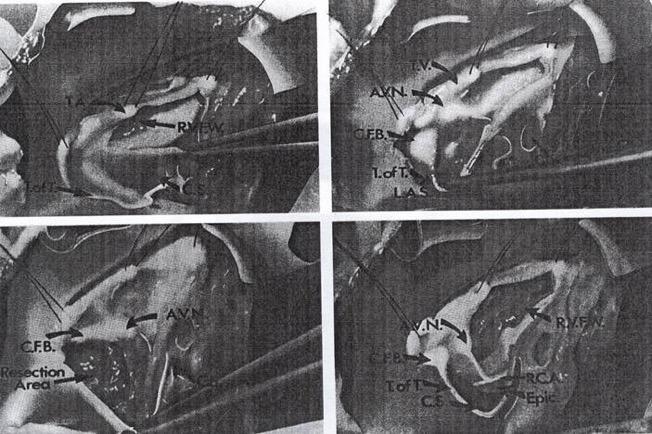 Endokardiyal diseksiyon Posterior Septal Space Posterior Septal