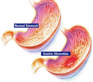 Nonsteroid Antiinflamatuvar İlaç