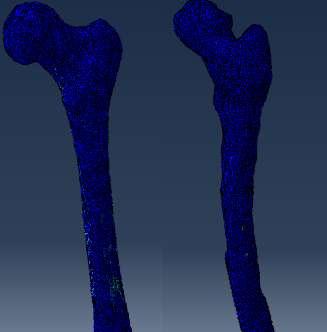 Sağlıklı A için, kalça displazisi olmayan normal iki bacak femur kemiği için de von- Misses gerilme değerleri bulunmuştur.