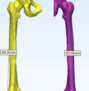 Sağ femur kemiği için bu değer 116 MPa, Sol femur kemiği için ise aynı şartlar altında 167 MPa olarak bulunmuştur. Her iki model içinde kritik ya da en yüksek gerilme değeri femur orta bölgesindedir.