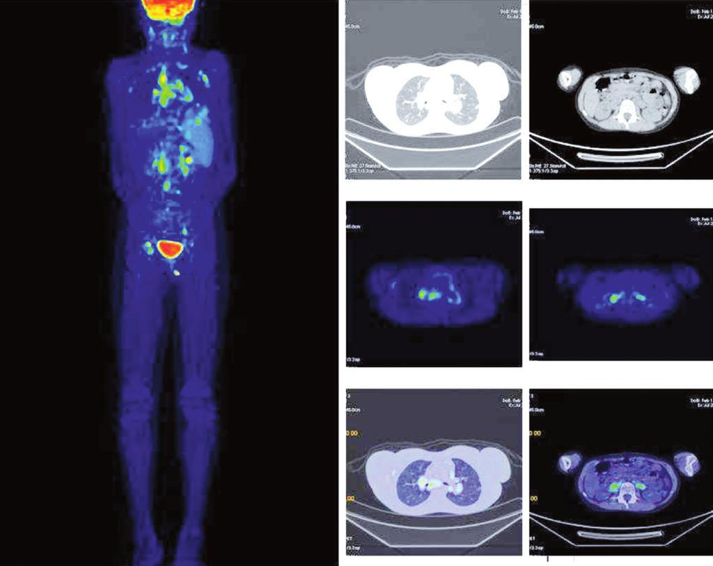 RESİM 3: 13 yaşında lenfoma tanılı kız hastada hastada ilk evreleme amaçlı yapılan tüm vücut PET/BT görüntüleme.