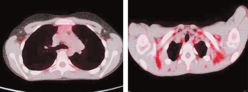 RESİM 4: Aksiyel PET/BT füzyon görüntülerinde solda reaktif timus hiperplazisi ve sağda kahverengi yağ dokusuna ait görünüm.