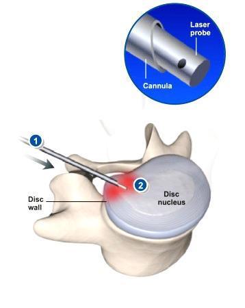 Vaporizasyon işlemi ve hemostatik Y-valvi sayesinde vaporizasyonun gerçekleşmesi Disk