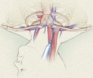 Sternal çentik, klavikula ve sternokleidomastoid kas gibi anatomik işaretler, steril işlem için yapılacak hazırlık öncesinde değerlendirilmelidir.