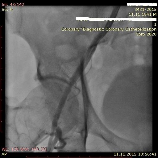 Figure 3: In control angiography right