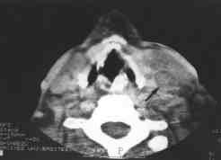 Birinci hastam z n bilgisayarl boyun tomografisinde sol internal juguler vende trombüs izlenmektedir.