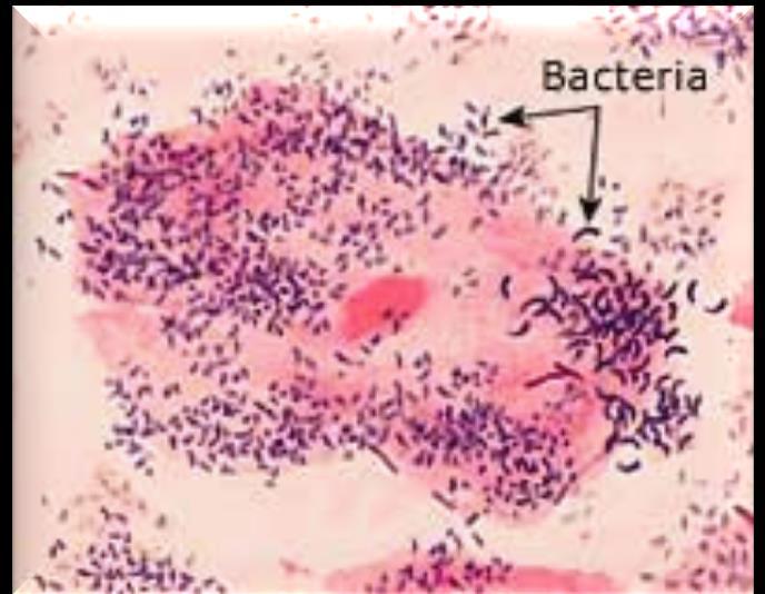 GENİTAL AKINTI Bakteriyel Vaginoz-Tanı Beyaz-gri homojen