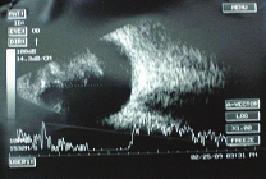 8 olan 66 gözde yapılan submaküler cerrahi ve vitrektomi esnasındaki gözlemlere göre 66 gözün 55 tanesinde (%83) posterior vitre korteksinde yapışıklık görülmüştür.