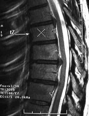 GİRİŞ Semptomatik torasik disk herniasyonu (HNP) genel populasyonda oldukça nadir görülür.