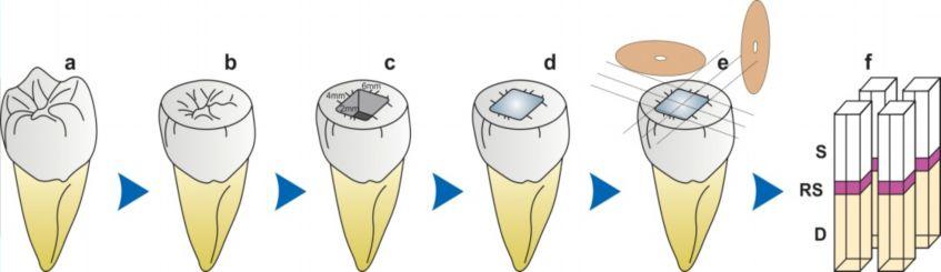 Seramik inley ve dentinden oluşan dişin kuronu, mine-sement birleşiminin yaklaşık 1-2 mm yakınına kadar mesiodistal yönde 1.2 mm genişliğinde su soğutması altında dilimlendi.