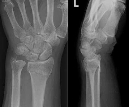 Ekstremite Yaralanmaları Yaşlı hastalarda açık el veya dirsek üzerine düşme sonucu Colles
