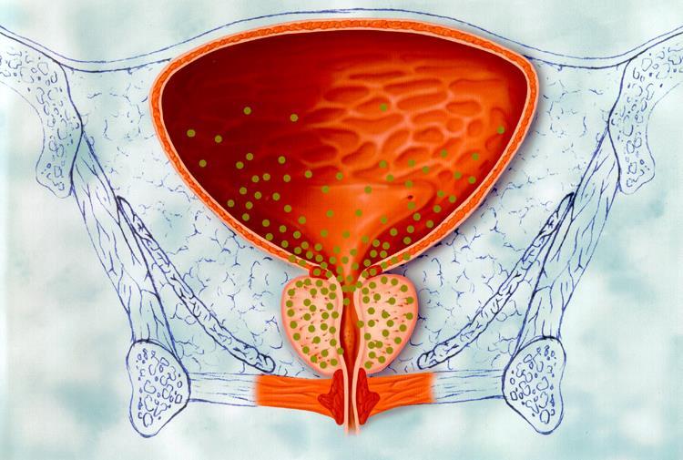 α1-adrenoreseptör Antagonistleri (α1-blokörler) Prostat içindeki düz