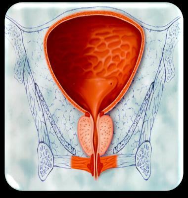 BPH+AÜSS Statik komponent Prostatın büyüyen dokularının direkt mesane boynu obstrüksiyonu