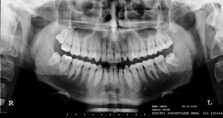 3. GEREÇ VE YÖNTEM Bu çalışma, Gazi Üniversitesi Diş Hekimliği Fakültesi Ağız, Diş, Çene Hastalıkları ve Cerrahisi Anabilim Dalı Kliniği ve T.C. Sağlık Bakanlığı 75.