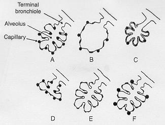 DLCO da azalma A. Normal B. Amfizem C.