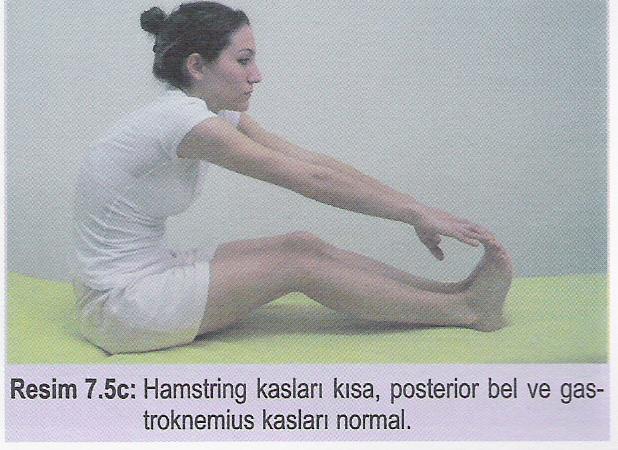 2) Hamstring kasları kısa, posterior bel