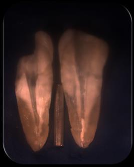 the root canal system: A scanning electron microscope study. J Conserv Dent.