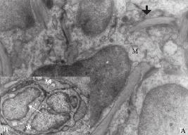 cisim, küçük resim: Apoptotik hücre (Uranil asetat- Kurşun sitrat x7000) Resim 2c: Aynı grubun stromasına ait elektron mikroskop resmi.