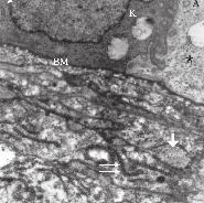 Yüzey epitelinde bazı hücrelerde apoptotik cisimlerin varlığı ilgi çekiciydi (Resim 3a). Epitel bazalinde hücreler koyu ve açık sitoplazmalı olarak ayırt ediliyordu.