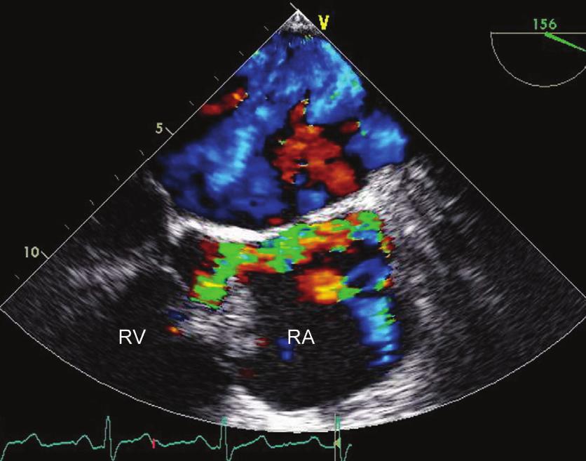 AKD ISSN 1302-8723 The Anatolian Journal of Cardiology Cilt Vol.