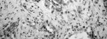 Paklitaksel, doksorubisin, tamoksifen ve sisplatin gibi kemoterapotik ajanlar kanser hücrelerinde NF-κB aktivasyonu ile