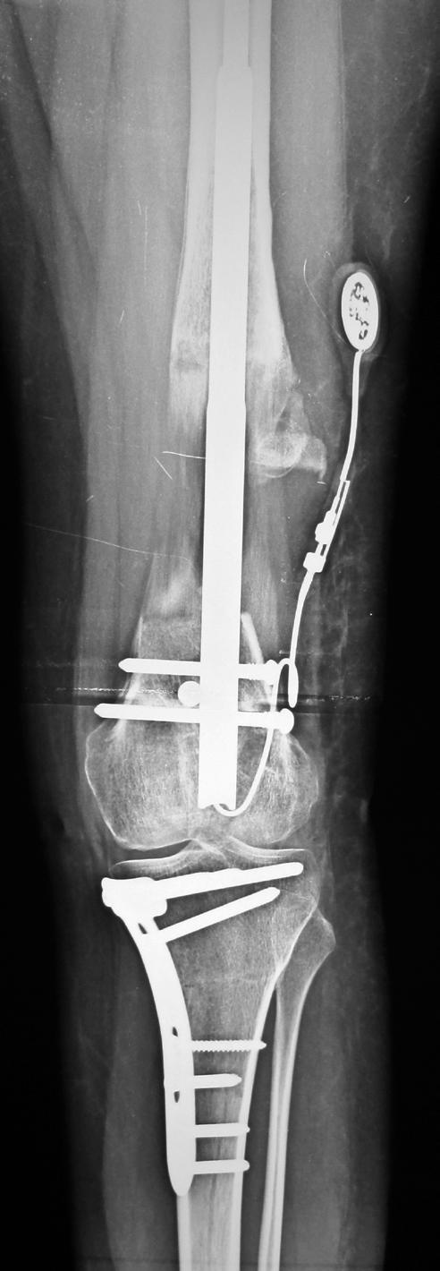 2 cm (4 6.5 cm) olarak hesaplandı. Gruplar arasında uzatma miktarı açısından bir farklılık saptanmadı. Birinci grupta ortalama deformite düzeltme miktarı 9 (5 15 ) idi.