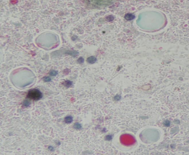 Resim 1 : Trikrom boyamada Blastocystis protozoonları. (Gazi Üniversitesi Tıp Fakültesi Tıbbi Mikrobiyoloji Anabilim Dalı Parazitoloji Laboratuvarında çekilmiştir.