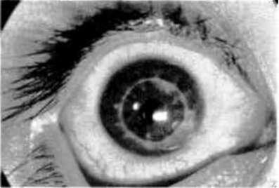 Thomas, C.I.: The Cornea. Springfield: Charlis C. Thomas pub., s. 1001-1022, 1955 6. Werb, A.: Indications for full-thickness keratoplasty. Corneal Grafting. Ed. T.A. Casey, London: Butterworths, s.