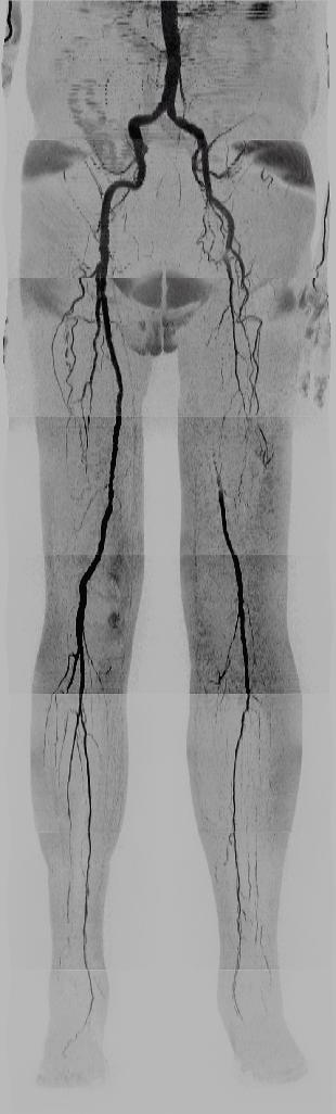 QISS görüntülerinde sol tarafta ayağa kadar arka tibiyal arterde akış bulunan tek damarın olduğu yüzeysel femoral arter tıkanması görüldü.