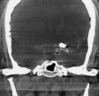 1A 1B 1 Servikal omurunda kurşun yarası bulunan bir hastanın dural kesesindeki ya da vertebral arterindeki merminin yönünü belirlemek için syngo