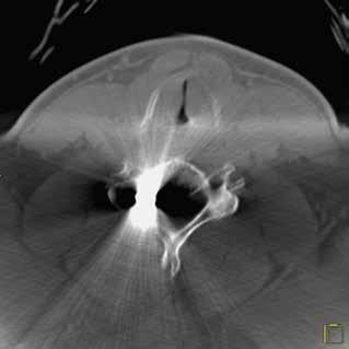 2A 2B 2 57 yaşında bir kadında sol internal karotid arter terminus anevrizmanın stent destekli coil i yapıldıktan sonraki görüntü.