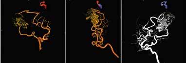 4 4 4D DSA nın (syngo Dyna4D) esnekliği AVM nidusunun, besleyen arterlerin ve drenaj damarlarının en iyi şekilde görüntülenmesi için
