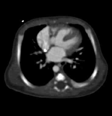 3C) images pulmoner show arteri the (yıldız), confluent pulmonary pulmoner atreziyi artery (Şekil (asterisks), 3B ve pulmonary 3C, kısa oklar), atresia bir sol (Figs.