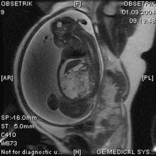 Perinatoloji Dergisi Cilt: 13, Say : 3/Eylül 2005 165 Bu bulgular ile obstetrik MR inceleme için Radyoloji klini ine refere edildi. Obstetrik MR inceleme 1.