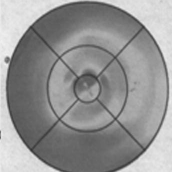 3.1.3. Spektral Optik Kohorens Tomografi OCT III version 4 cihazı (Carl Zeiss Meditec, Humphrey Division, Dublin CA.