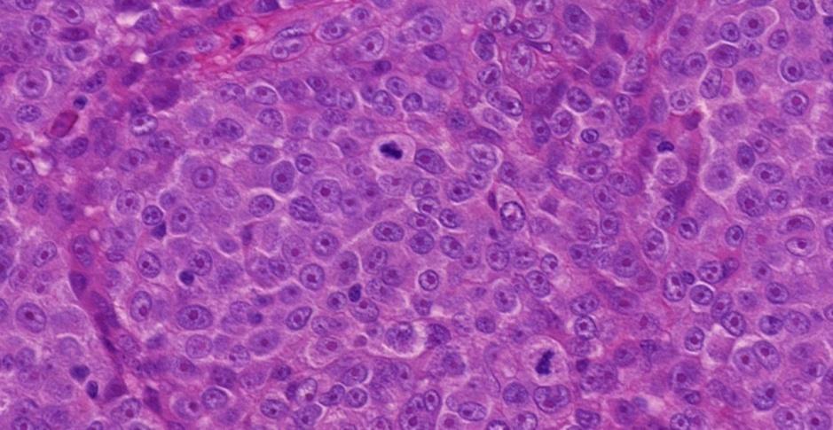 Mitozlar Yuvarlak şekilli (epitelioid) melanositik tümöral