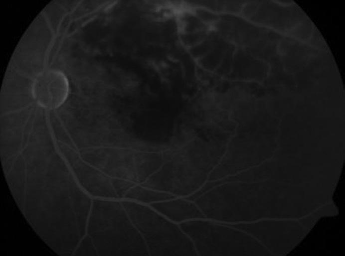 Diğer gözde tıkanıklık riskini azaltmak için uygulanacak en iyi yöntem, retinal ven tıkanıklığı ile ilişkili hastalıkların araştırılması ve tedavi edilmesidir.