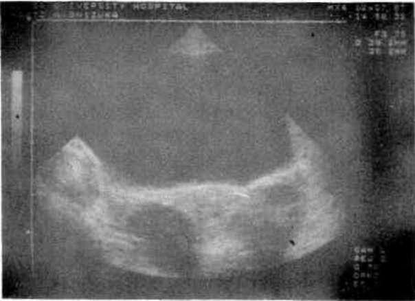 Teka Lutein Kistleri Genellikle trofoblastik hastalıklarda ve ovulasyon induksiyonu yapımış gebelerde görülmektedir. Ultrasonik olarak bilateral ve sıklıkla multilobuler büyük kistlerdir (Şekil 4).