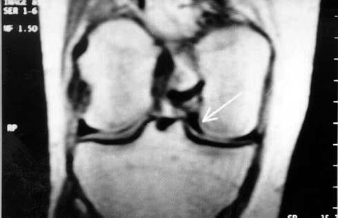 ARTROPLASTÝ ARTROSKOPÝK CERRAHÝ / JOURNAL O ARTHROPLASTY ARTHROSCOPIC SURGERY 9 Resim 2: T1 A sagital ve koronal kesitlerde, medial menisküste bir kýsmý interkondiler çentiðe doðru yer deðiþtirmiþ