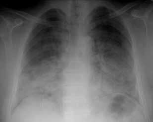 Pulmoner alveoler proteinozisli hastada iki taraflı total akciğer lavajı GİRİŞ Pulmoner alveoler proteinozis (PAP) ilk kez 1958 de Rosen ve arkadaşları tarafından tanımlanmış, nadir görülen, difüz